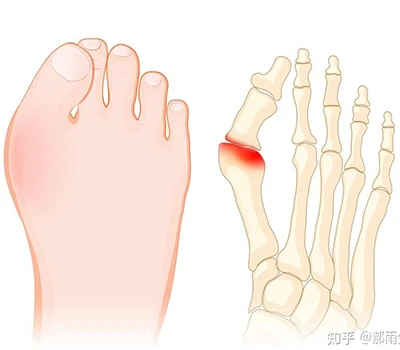 Hallux Valgus: täielik teadusjuhend